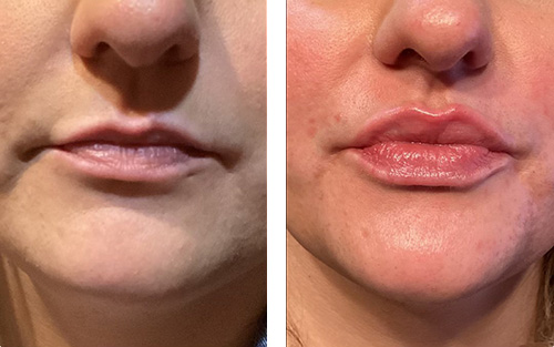 Dermal Filler Ashland KY - Before & After Lower Face and Lip Treatment